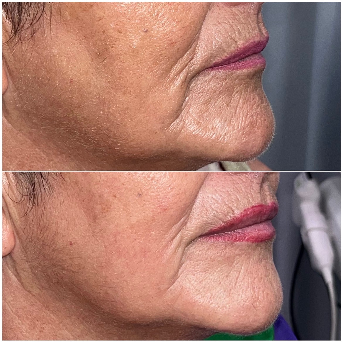 Metamorphose · 8 semanas: 1 HIFU + 2 radiofrecuencias + 1 microneedling