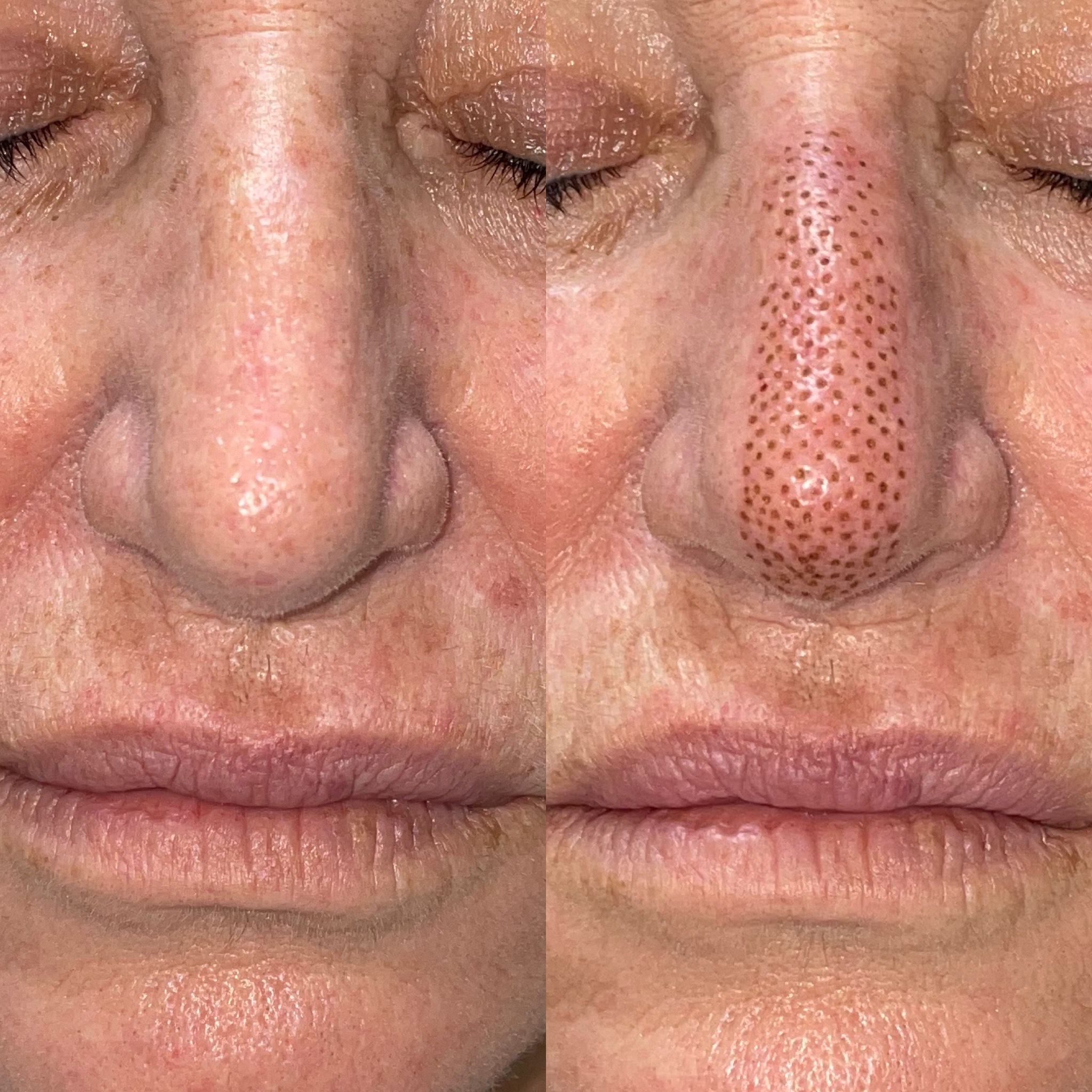 Plasma · vista frontal nasal: Mismo caso, vista frontal · antes e inmediatamente después